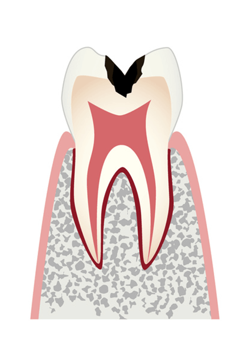 さらに、むし歯が象牙質という層まで進行した状態です